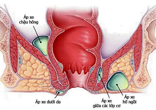 Áp xe