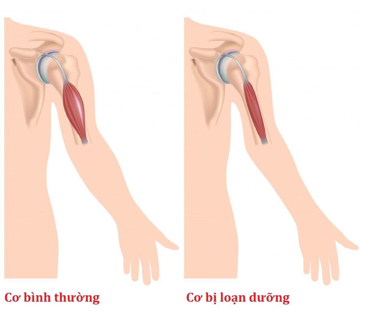 Bệnh loạn dưỡng cơ Duchenne